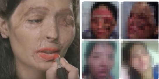 Συγκινητικό!! Γυναίκα θύμα επίθεσης με οξύ παραδίδει μαθήματα μακιγιάζ!! (βίντεο)